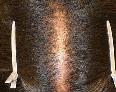 Before image showing the scalp of a person with hair thinning and clips holding back their hair.